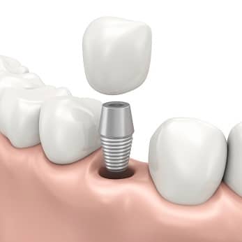 Dental implants