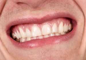 Dentist for Gum Disease in West Chester PA Area