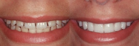 Porcelain veneers