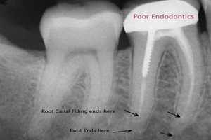 Root Xray case 02