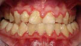 Gum disease teeth
