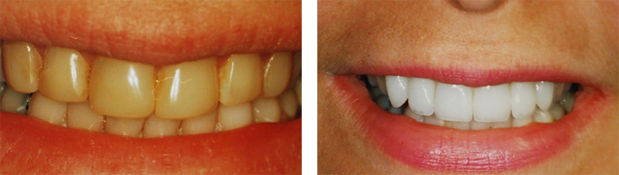 Porcelain Veneers near West Chester PA