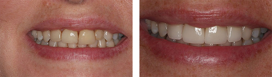 Teeth Restoration near West Chester PA - treatment Images