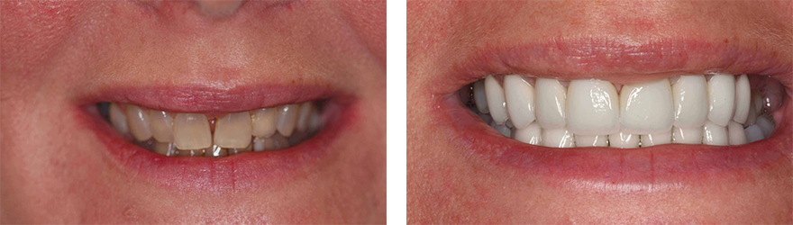 Smile Makeover near West Chester PA - treatment Images