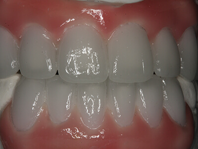 A Close-up of the Wax Impression of the Smile Desired at Briglia Dental Group in West Chester, PA Area