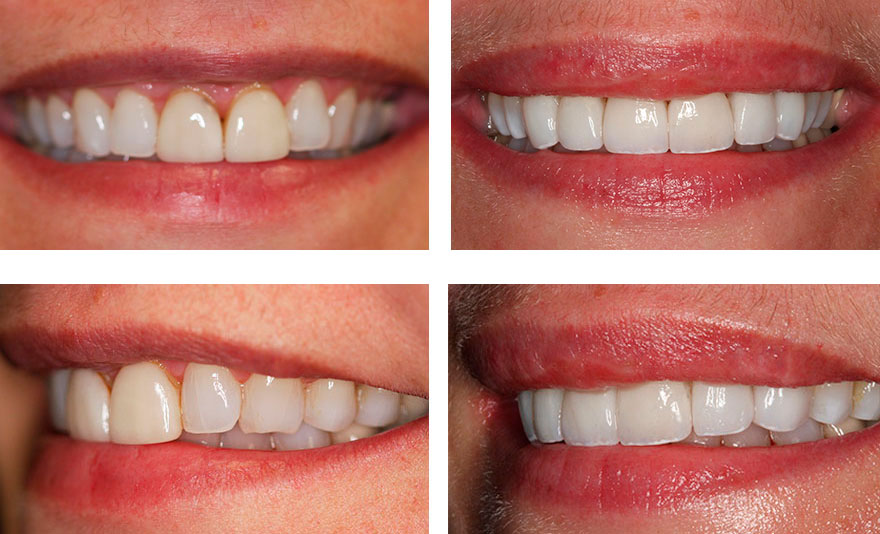 Antes e depois dos resultados do tratamento de maquiagem do sorriso em West Chester, PA (Causa 1)
